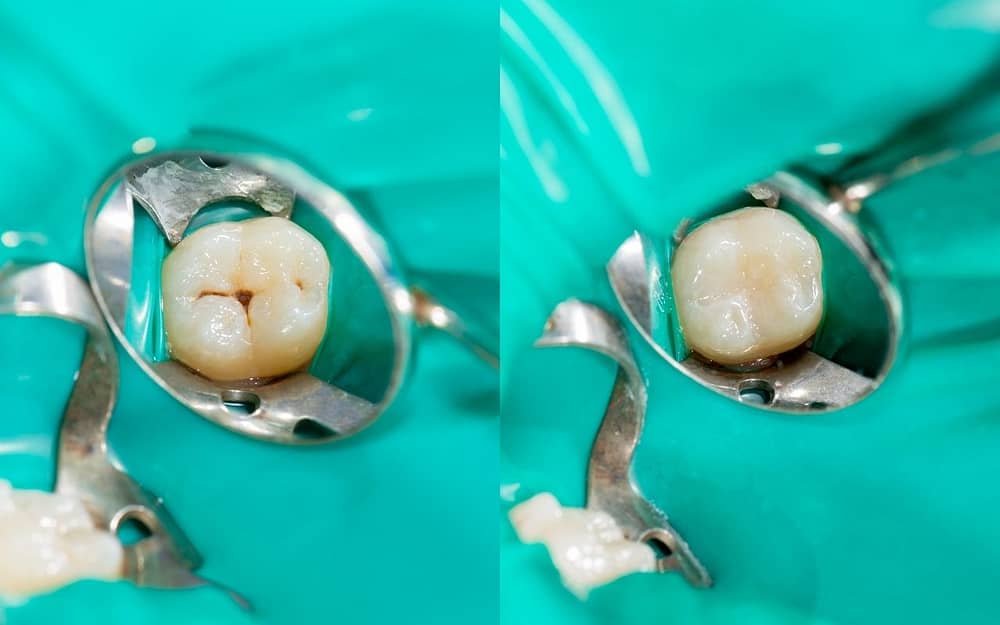 dental-sealants-for-tooth-decay-Bradford-Dentist