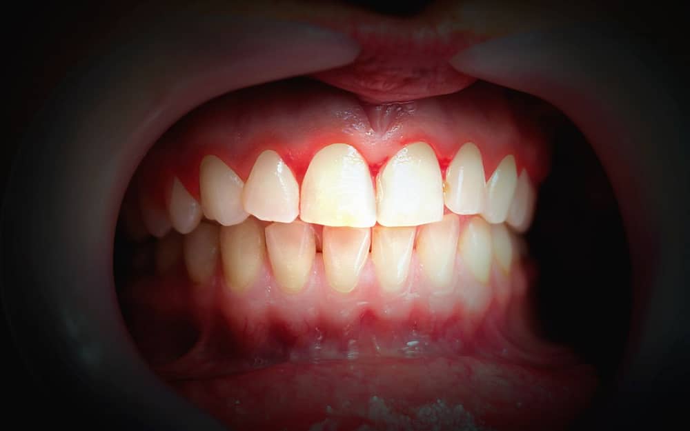 stage-3-gum-disease-early-periodontitis