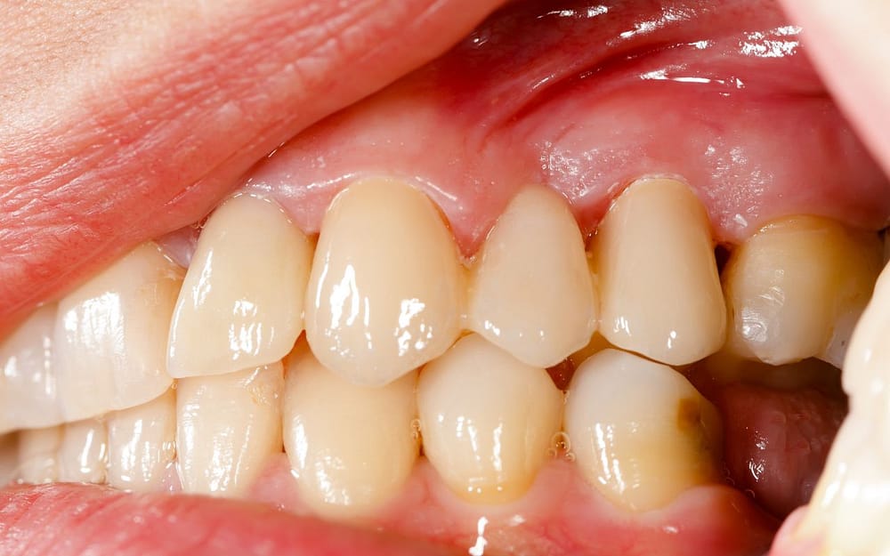 stage-4-gum-disease-moderate-periodontitis