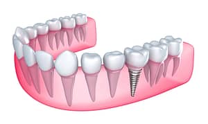 Bradford Dental Implants How it works