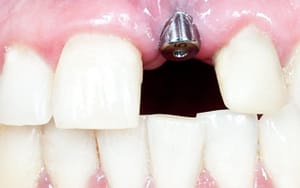 Dental Implant Abutment - Bradford Family Dentist