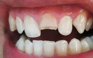 dental-emergency-broken-tooth