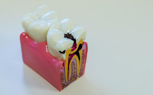 Dental Abscess Infection - Bradford Family Dentist