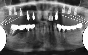 Dental Implant Posts - Bradford Family Dentist