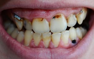 Vaping Gum Disease - Bradford Family Dentist