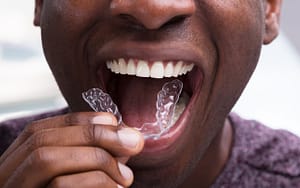 A man wearing clear aligners to correct his teeth.