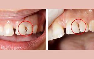 A woman's teeth showcase the before and after effects of a dental implant, comparing the pros and cons of different types.