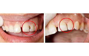 A woman's teeth are shown before and after a dental filling, highlighting different types of dental fillings.