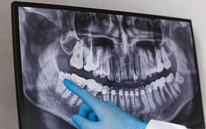 A dentist is pointing at an x-ray of a patient's teeth, explaining the causes of impacted wisdom teeth.