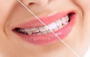 A woman's teeth transformation before and after braces, with tips to relieve braces pain.