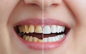 A woman's teeth transformation before and after cosmetic dentistry.