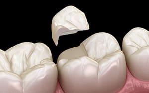 An image depicting restorative dentistry with a missing tooth.