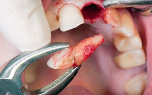 A dental emergency arises when a person's tooth is extracted using pliers while travelling.