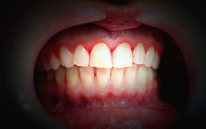 A close up of a person's mouth showing signs of periodontitis.