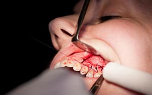 A dentist examining a woman's mouth for gum disease.