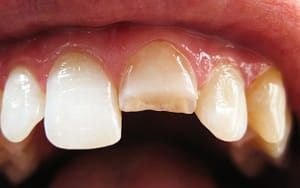 A close up of a person's teeth after braces with white fillings.