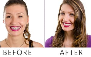 A woman's teeth transformation before and after braces.