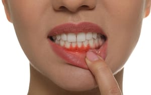 early-signs-of-gum-disease
