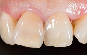 progressive-signs-of-gum-disease