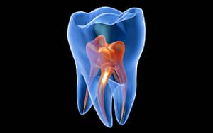 An image of an actual tooth with orange and blue colors.