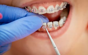 a-typical-orthodontic-visit-involves-adjustment-and-replacement-of-archwires-and-rubber-bands