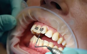 A person's teeth are being fitted with dental implants during a typical orthodontic visit.
