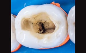 A painful tooth with a hole in it is shown on a blue surface.