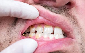 what-is-dental-erosion-sports-drinks-vs.-energy-drinks-and-your-teeth