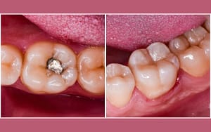 cavities-and-aging-fillings-in-30s-oral-care-through-the-years