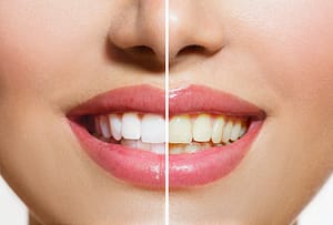 Bradford Family Dentistry Teeth Whitening