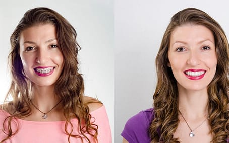 braces-before-and-after-Bradford-Family-Dentistry